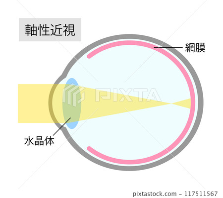 Simple illustration of an eye with axial myopia Simple illustration of an eye with axial myopia 117511567