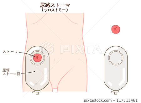 泌尿道造口、造口、尿道造口、造口、插圖 泌尿道造口、造口、尿道造口、造口、插圖 117513461