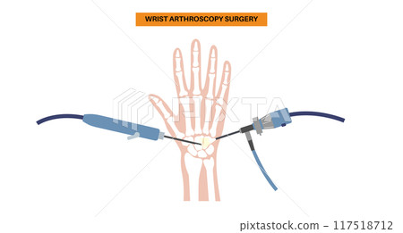Wrist arthroscopy surgery Wrist arthroscopy surgery 117518712