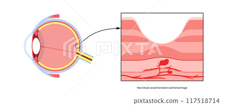 Macular degeneration poster 117518714