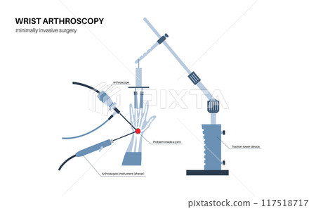 Wrist arthroscopy surgery Wrist arthroscopy surgery 117518717
