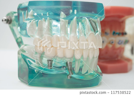 Artificial tooth roots dental implant into jaw, Root canal model for dentist. 117538522