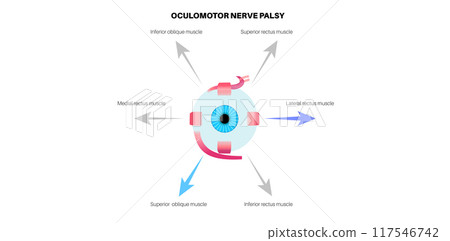 Oculomotor nerve palsy 117546742