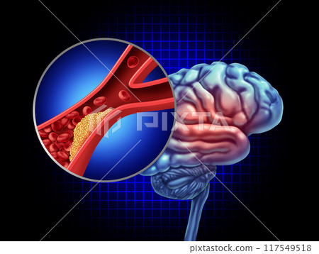Transient Ischemic Attack 117549518