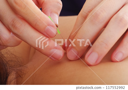 一名婦女在針灸診所接受背部針灸治療 一名婦女在針灸診所接受背部針灸治療 117552992