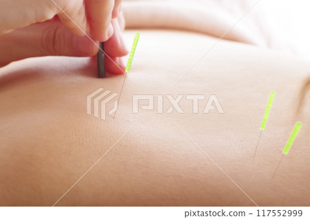 一名婦女在針灸診所接受背部針灸治療 117552999