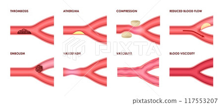 Vein diseases of thrombosis, atheroma and vasculitis with blood viscosity, vector medical infographic icons. Vein diseases of vascular artery compression, vasospasm, embolism and reduced blood flow 117553207