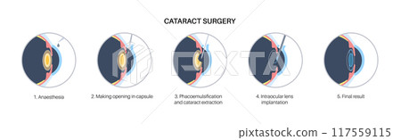 Cataract surgery poster 117559115