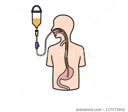 Nasogastric tube feeding 117573842