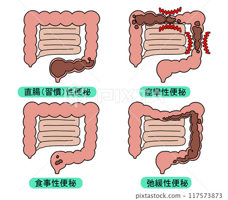 便秘的類型 117573873
