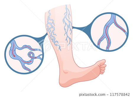 Varicose veins. Blue blood vessel visible through the skin, abnormally swollen leg. Vascular disease diagnostic and treatment. Venous insufficiency medical disease Varicose veins. Blue blood vessel visible through the skin, abnormally swollen leg. Vascular disease diagnostic and treatment. Venous insufficiency medical disease 117578842