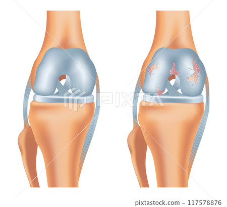 Knee arthrosis. Healthy knee and sore knee with damaged structure. Bone exposure damaged and healthy knee structure comparison. Medical poster with foot bones. Isolated vector illustration 117578876
