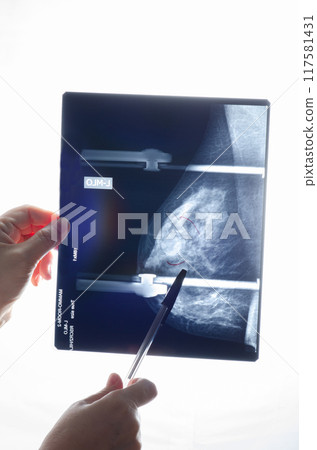 Through the Lens of Prevention: How Advanced Mammography Techniques are Revolutionizing Early Detection of Breast Abnormalities. 117581431