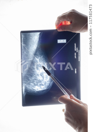 Decoding Breast Health: Inside the Crucial Moments of Right Breast MLO Mammogram Analysis in the Fight Against Cancer. 117581473