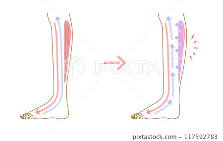 腳部腫脹:腫脹原因的圖示(橫斷面圖) 腳部腫脹:腫脹原因的圖示(橫斷面圖) 117592783