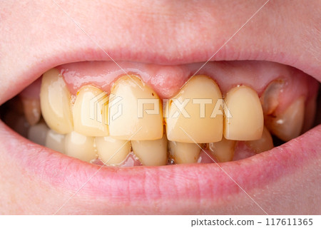 Bad damage tooth, lost teeth Bad damage tooth, lost teeth 117611365
