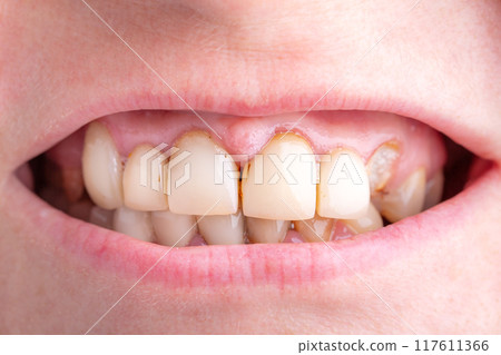 Bad damage tooth, lost teeth Bad damage tooth, lost teeth 117611366