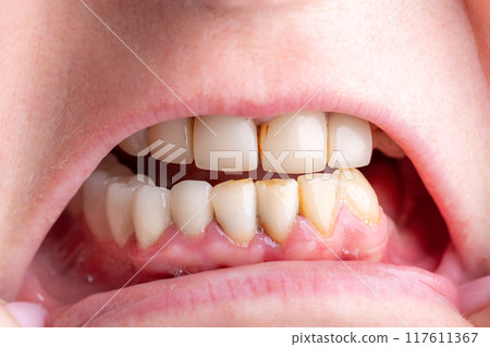 Bad damage tooth, lost teeth 117611367