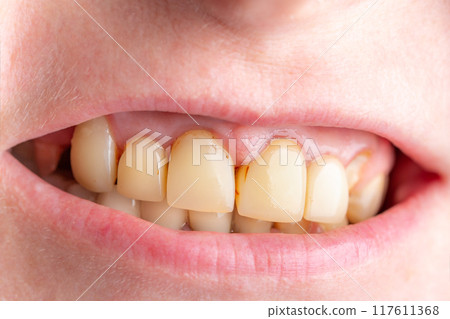 Bad damage tooth, lost teeth Bad damage tooth, lost teeth 117611368