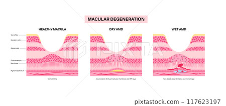 Macular degeneration poster 117623197
