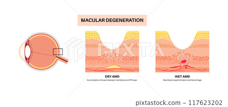 Macular degeneration poster Macular degeneration poster 117623202