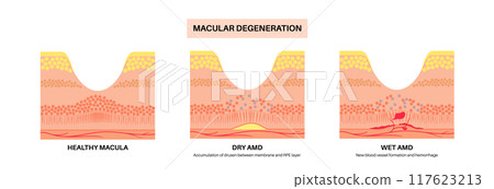 Macular degeneration poster 117623213