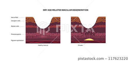 Macular degeneration poster 117623220