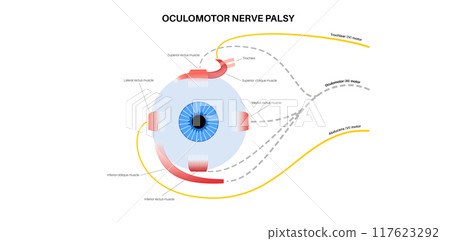 Oculomotor nerve palsy 117623292