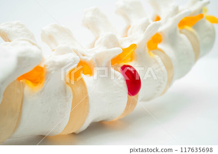 Lumbar spine displaced herniated disc fragment, spinal nerve and bone. Model for treatment medical in the orthopedic department. 117635698