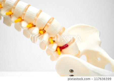 Lumbar spine displaced herniated disc fragment, spinal nerve and bone. Model for treatment medical in the orthopedic department. 117636399