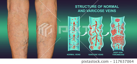 Deep Vein Thrombosis or Blood Clots. Embolus. Structure of normal and varicose female veins 117637864