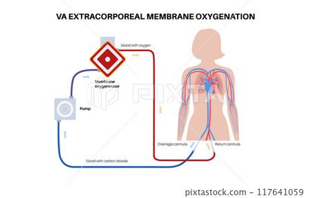 Extracorporeal membrane oxygenation Extracorporeal membrane oxygenation 117641059