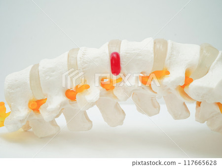 Spinal nerve and bone, Lumbar spine displaced herniated disc fragment, Model for treatment medical in the orthopedic department. Spinal nerve and bone, Lumbar spine displaced herniated disc fragment, Model for treatment medical in the orthopedic department. 117665628