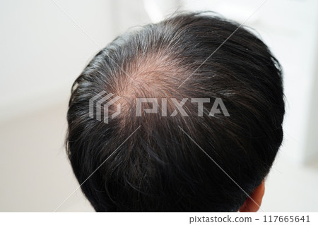 Bald head in man, hair loss treatment health problem. 117665641