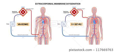 Extracorporeal membrane oxygenation Extracorporeal membrane oxygenation 117669763