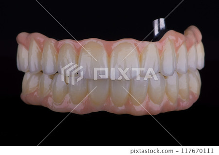 Dental zirkonium prosthesis of upper and lower jaw on titanium bars stained by ceramic stains. 117670111