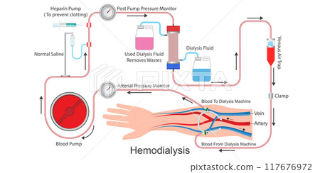 Hemodialysis is a treatment to filter wastes and water. Hemodialysis is a treatment to filter wastes and water. 117676972