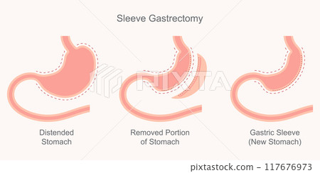 Sleeve gastrectomy, part of the stomach. 117676973