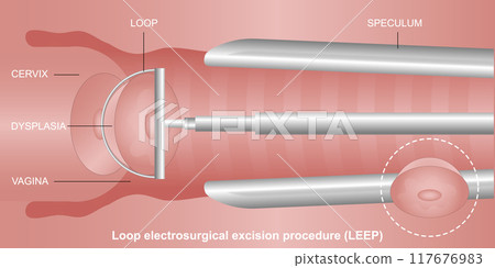 A LEEP (loop electrosurgical excision procedure). A LEEP (loop electrosurgical excision procedure). 117676983