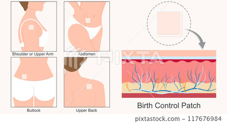 Birth Control Patch is square patch that sticks to the skin. 117676984