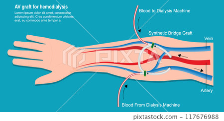 An arteriovenous (AV) graft is a type of access used for hemodialysis. An arteriovenous (AV) graft is a type of access used for hemodialysis. 117676988