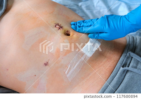 Hands of medic or nurse in blue gloves examining a fresh suture on a male stomach after laparoscopy surgical removal of appendicitis. Doctor examines of the patient. Man belly with medical stitches 117680894