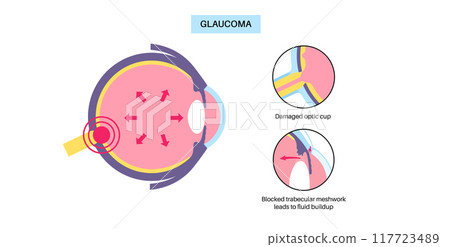Glaucoma eye disease 117723489