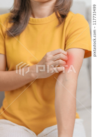 woman itching and scratching itchy arm. Sensitive Skin Allergic reaction to insect bite, food, drug dermatitis. Dermatology, Leprosy day, Systemic lupus erythematosus, Allergy symptoms and rash Eczema 117733499