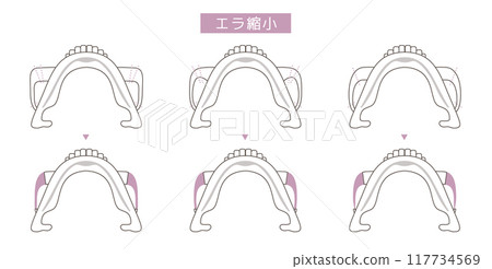 Illustration of jaw reduction surgery method 117734569