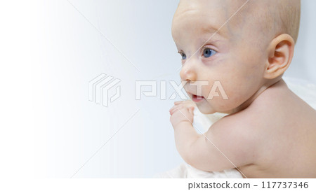 a baby with a hemangioma on his neck lies on a white background a baby with a hemangioma on his neck lies on a white background 117737346