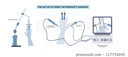 Wrist arthroscopy surgery 117758045