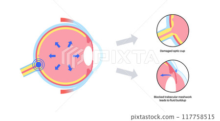 Glaucoma eye disease Glaucoma eye disease 117758515