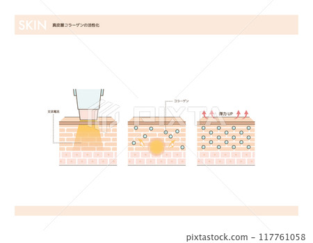 高頻治療活化真皮層膠原蛋白示意圖 117761058