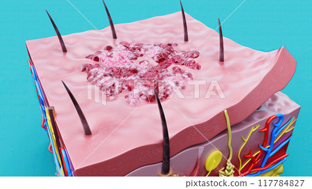 Abstract illustration of the skin and the herpes virus or cancer Abstract illustration of the skin and the herpes virus or cancer 117784827